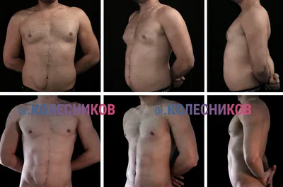 Устранение гинекомастии