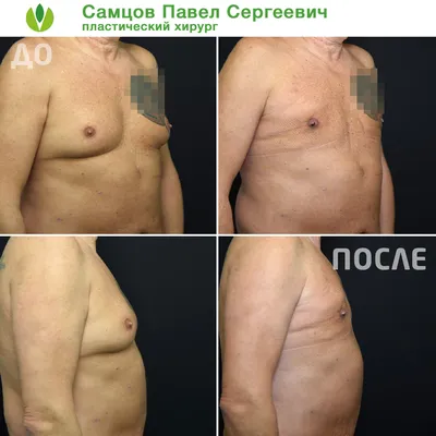Удаление гинеком в Турции: цены клиники в Стамбуле