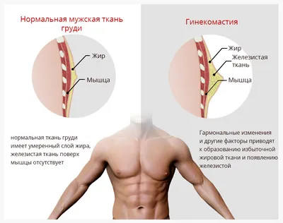 Удаление гинекомастии, уменьшение груди у мужчин в Киеве | Доктор Зыков