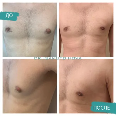 Коррекция гинекомастии у мужчин (фото до и после) – Исамутдинова Г. М.