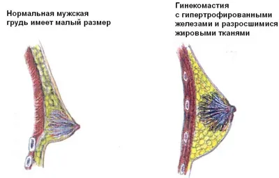 Гинекомастия у мужчин: лечение, симптомы, причины. Современные методы  лечения в клинике \"СОЮЗ\"