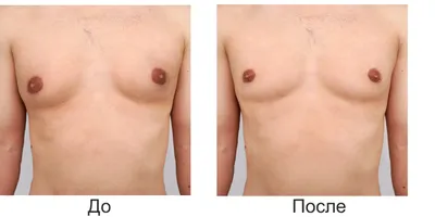 Коррекция гинекомастии у мужчин (фото до и после) – Исамутдинова Г. М.