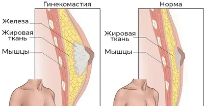 Новости МДЦ \"Олимп\": Гинекомастия у мужчин