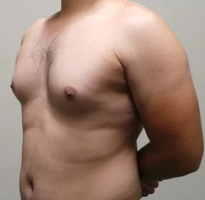 Медицинский центр Комрец - Гинекомастия – это доброкачественное заболевание  грудных желёз у мужчин, которое происходит за счет разрастания железистой  ткани. Проявляется гинекомастия видимым увеличением грудной железы,  уплотнением железистой ткани ...