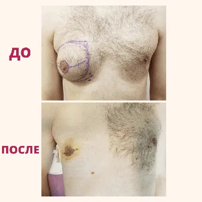 Коррекция гинекомастии: ДО/ПОСЛЕ | Маммологический Центр