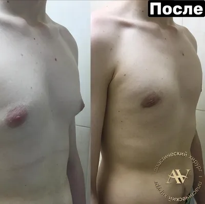 Гинекомастия у мужчин стоимость операции в СПб