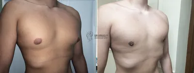 Гинекомастия: фото до и после операции