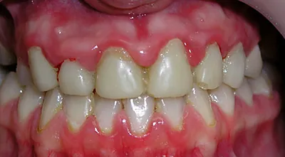 Гингивит | Причины, лечение | Клиника семейной стоматологии Дока-Дент
