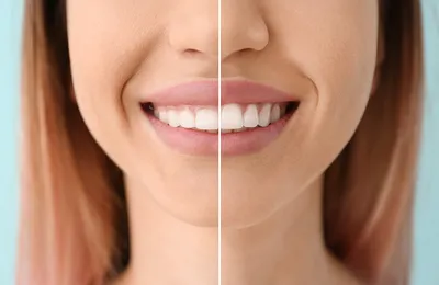 Коррекция контура дёсен в стоматологии Лекта Мытищи