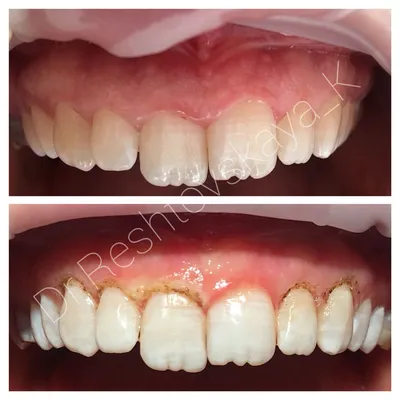 Наращивание и пластика дёсен (гингивопластика) - стоматология МАЙ