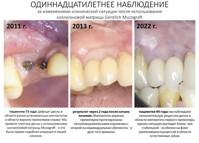 Пластика десны или гингивопластика под наркозом или седацией