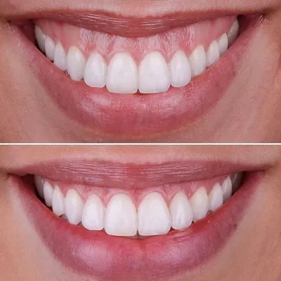 Фото до и после - Имплантация зубов - клиника Seline