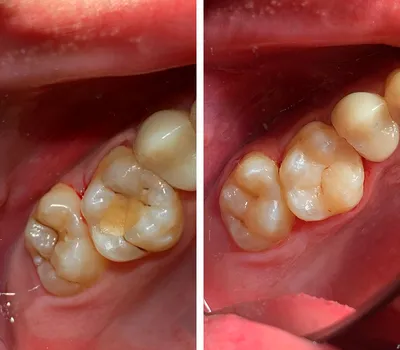 Лечение кариеса, фото до и после, пример работы 42973