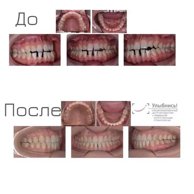 Кариес дентина 26, 27 зубов, до и после лечения - MagicDent