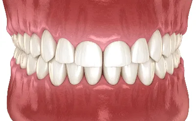 Пластика мягких тканей в стоматологии: эффективные хирургические  вмешательства в «Зуб Лечить!»