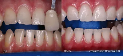Реставрация переднего зуба, фото до и после, пример работы 32105