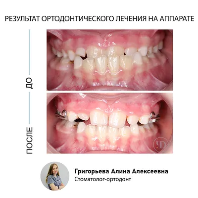 Художественная реставрация зубов в Москве: цены, фото до и после, отзывы |  Стоимость художественной реставрации зубов в клинике Seline