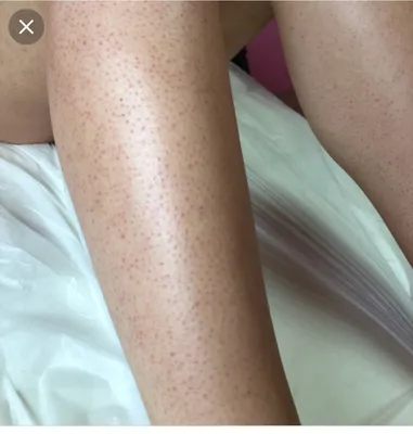 Коцiк дерматолог on X: \"Фолликулярный гиперкератоз это состояние кожи(не  заболевание!), при котором образуются узелки ороговевшего эпидермиса в  устьях волосяных фолликулов. (фото взяты из интернета)  https://t.co/Pl9T9Dudd0\" / X