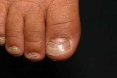 Гиперкератоз ногтей и кожи – как распознать и лечить заболевание, причины,  симптомы, профилактика