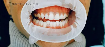 Лечение десен с помощью лазера - Akar Dental