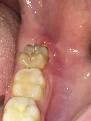 Лечение гиперплазии десен в стоматологии