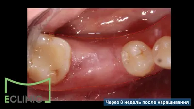 Пластика десны [гингивопластика и наращивание десны]