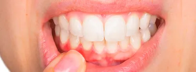 Чем лечить воспаление десен у взрослых – стоматология ПрезиДЕНТ