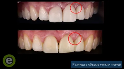 Пластика десны - зачем и как делают, сколько заживает десна после операции