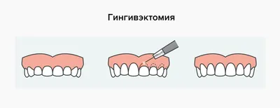 Ортоэкструзия для увеличение объема десны