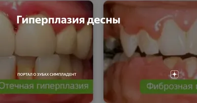 Гиперплазия десны, причины и лечение - Studio Dentistico Cozzolino - Блог  стоматологической клиники ARDIS-DENT