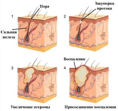 Удаление невуса Ядассона у лиц молодого возраста