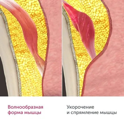 Инъекции в жевательные мышцы. Дичь или необходимость? Разберёмся на моём  примере. Рассказ о процедуре и фото | Отзывы покупателей | Косметиста