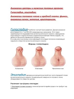 Гипоспадия у мальчиков - причины, формы, диагностика, консультация хирурга  | Москва
