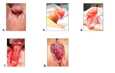 Гипоспадия фото до и после операции фотографии