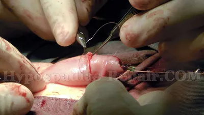 Как проходит операция и послеоперационный период после коррекции гипоспадии  в клинике Белграда