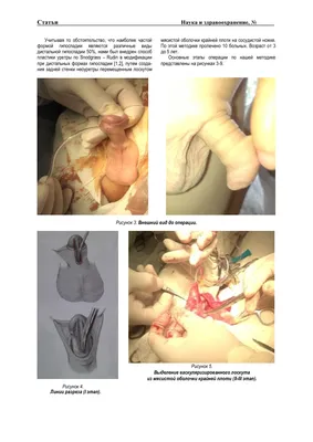 Сравнительный анализ методов лечения дистальной формы гипоспадии у детей