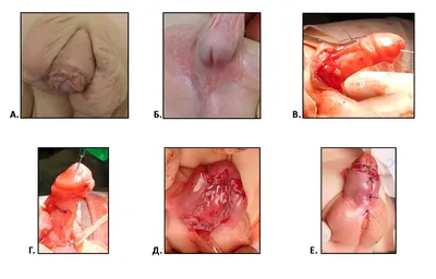 Гипоспадия у мальчиков - причины, формы, диагностика, консультация хирурга  | Москва