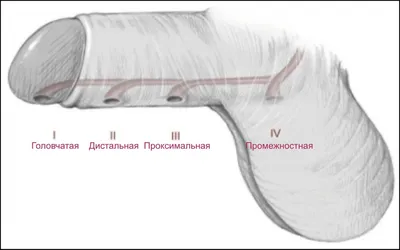 Гипоспадия: что это, симптомы, причины, диагностика, лечение