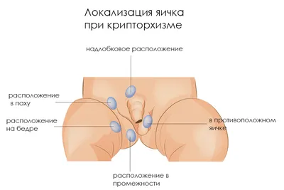 Гипоспадия: причины аномалии деликатной зоны и как избавиться | Royal  Medical Traiding | МЕДИЦИНА И ТЕХНИКА | Дзен