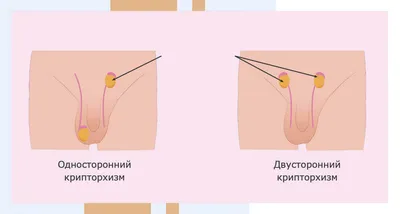 Нарушения формирования пола у детей