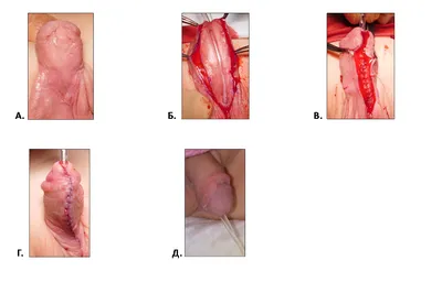 Эписпадия: причины,симптомы, диагностика, лечение