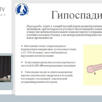 Гипоспадия | Рудин Юрий Эдвартович - Детская урология-андрология