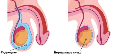 Лечение послеоперационных осложнений гипоспадии у детей – тема научной  статьи по клинической медицине читайте бесплатно текст  научно-исследовательской работы в электронной библиотеке КиберЛенинка