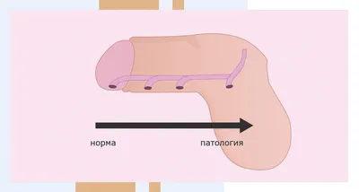 Осложнения со стороны мочеполовой системы у девочек с нарушением  формирования пола и гипоспадией | Аникиев | Эндокринная хирургия