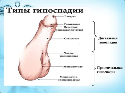 гипоспадия #детскаяурология #urology... - Moscow_urocenter | Facebook