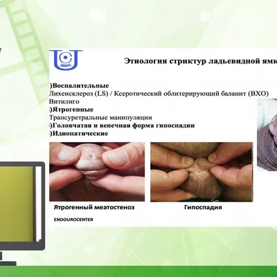 Эписпадия у детей - операция, лечение в центре андрологии в Москве!