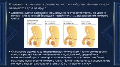 ВЫБОР ЛЕЧЕБНОЙ ТАКТИКИ У ДЕТЕЙ ПРИ ГИПОСПАДИИ