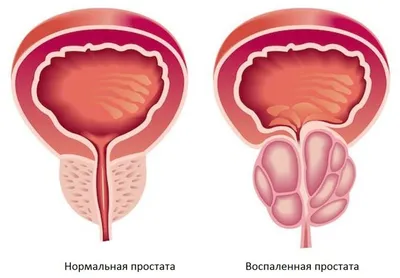 ▷Гипоспадия – порок полового члена у детей ✓Лечение гипоспадии в ADONIS