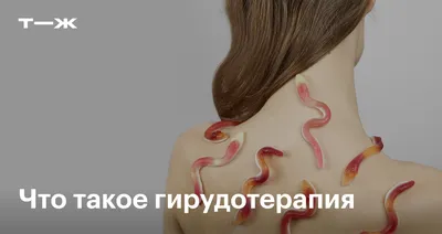 ЛЕЧЕНИЕ ПИЯВКАМИ ИЛИ ГИРУДОТЕРАПИЯ | Kingitus.ee