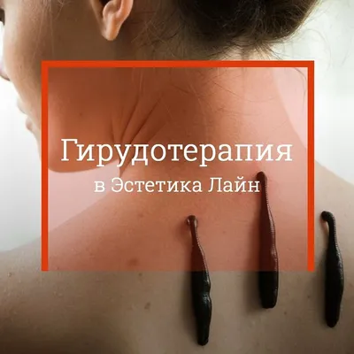 Гирудотерапия - Санаторий Обуховский Cвердловская область
